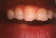 Grinding Teeth - A Selfie Perspective