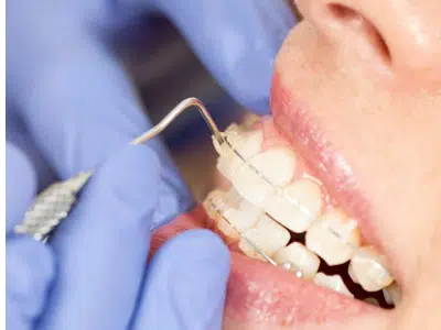 Woman Showing teeth aligners